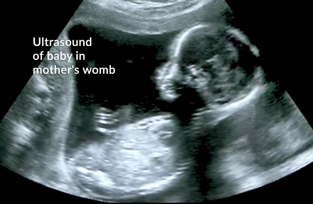 Ultrasound of Baby In The Womb